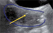 Advantages of real-time transabdominal ultrasound guidance in combined interstitial/intracavitary cervical brachytherapy: a case-based review