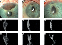 Radiological and clinical findings in uveal melanoma treated by plaque interventional radiotherapy (brachytherapy): Visual atlas and literature review on response assessment