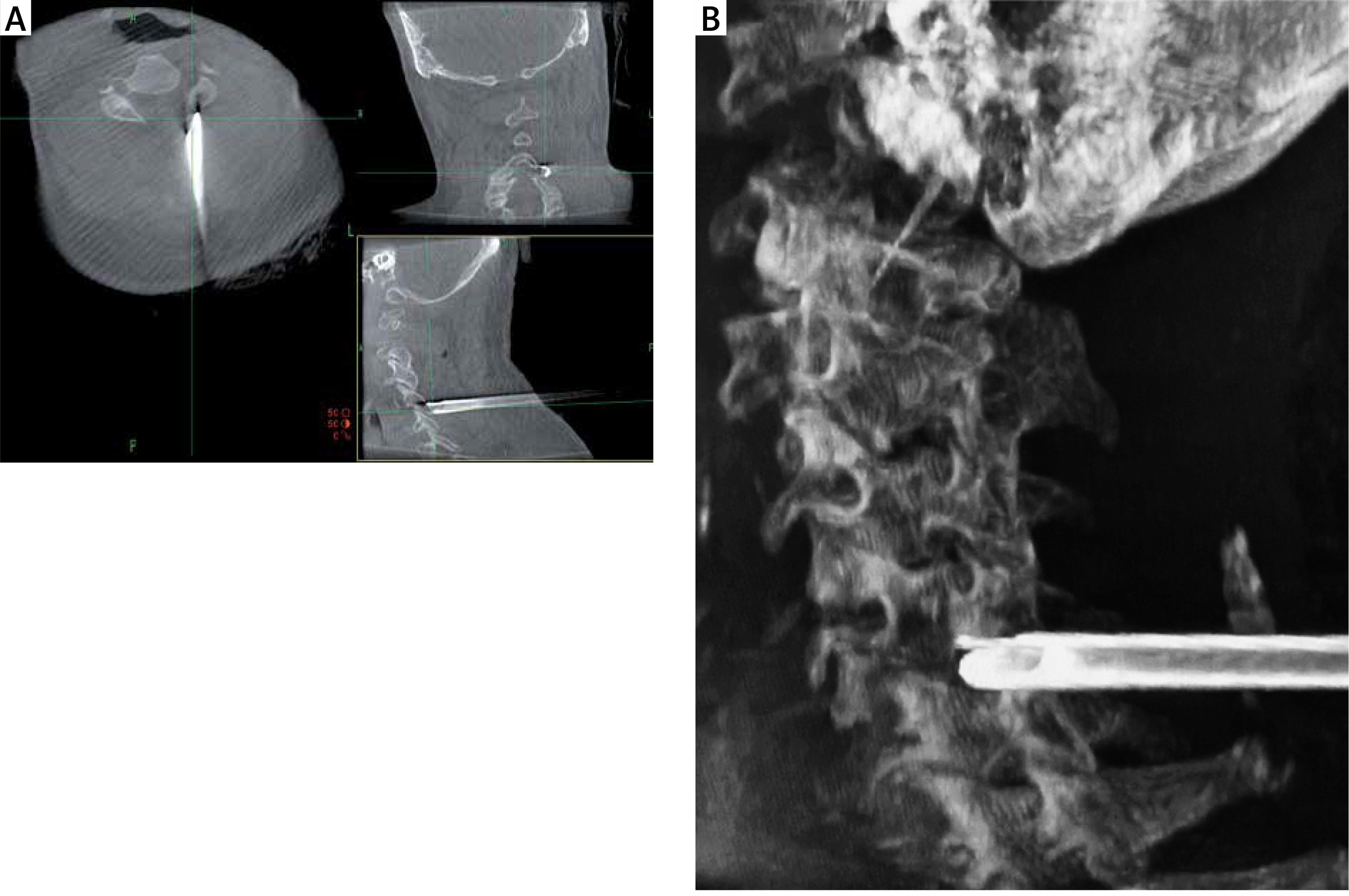 Posterior Percutaneous Endoscopic Cervical Foraminotomy And Discectomy For Degenerative Cervical