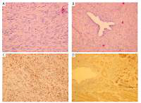 Benign metastasizing leiomyoma in triple location: lungs, parametria and appendix