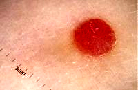 Strategies for enhancing melanoma detection in clinical practice and improving patient outcomes